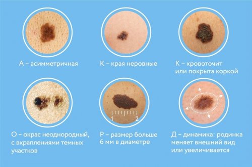 Как выявить опасную родинку