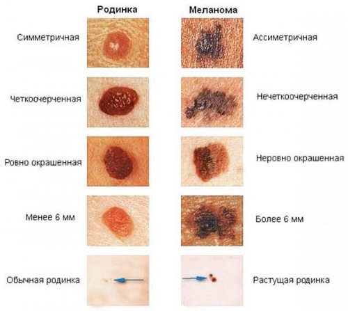 Обычная родинка/Меланома