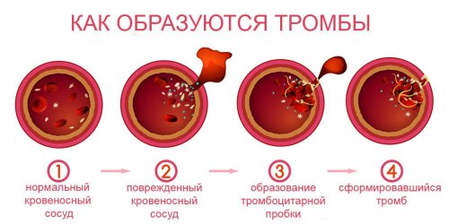 Как образуется тромб