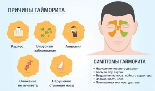 Причины и симптомы гайморита
