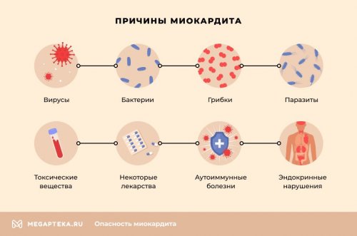 Что вызывает миокардит