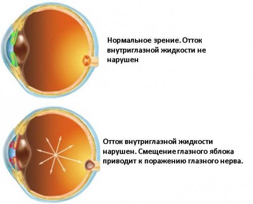 Что такое глаукома