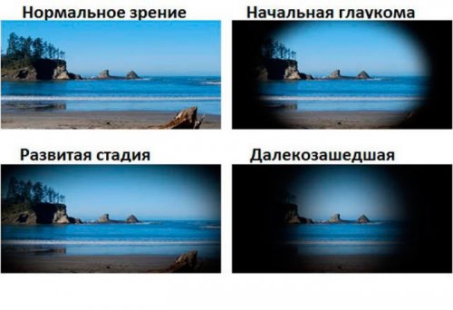 Как видит человек с глаукомой