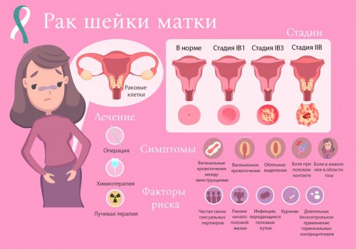 Рак шейки матки: симптомы, факторы риска, лечение