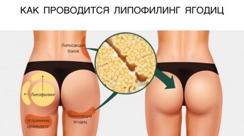 Липофилинг ягодиц