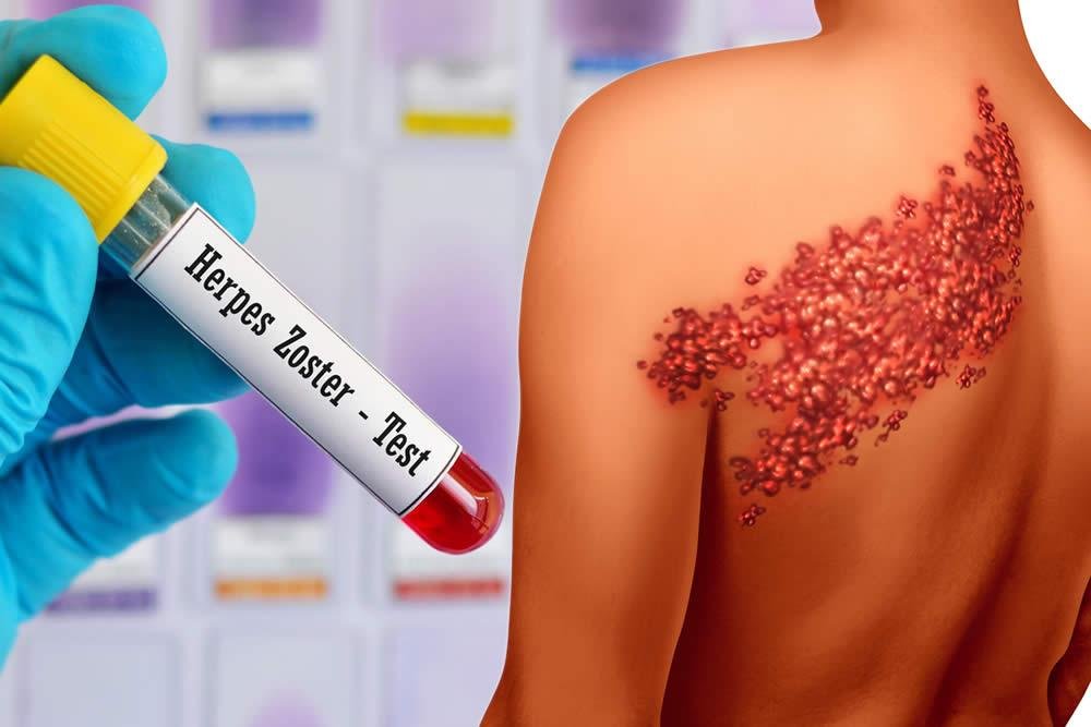 Опоясывающий лишай: причины, симптомы, лечение