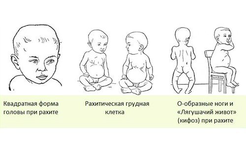 Проявления рахита у ребенка