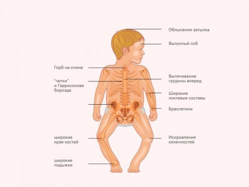 Последствия рахита у ребенка