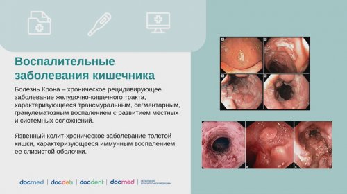 Воспалительные заболевания кишечника