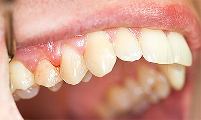 Топ-5 лучших гелей от воспаления десен