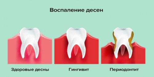 Воспаление десен