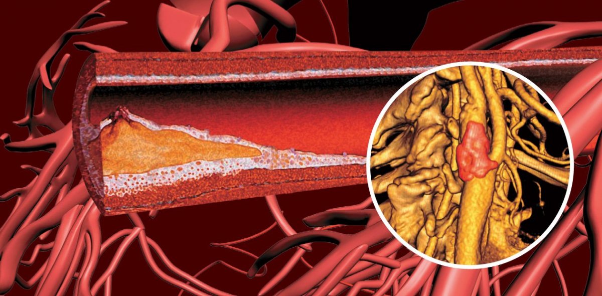 Кардиологи предупреждают: какие продукты вызывают атеросклероз