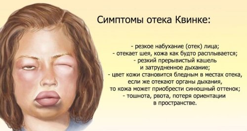 Отек Квинке