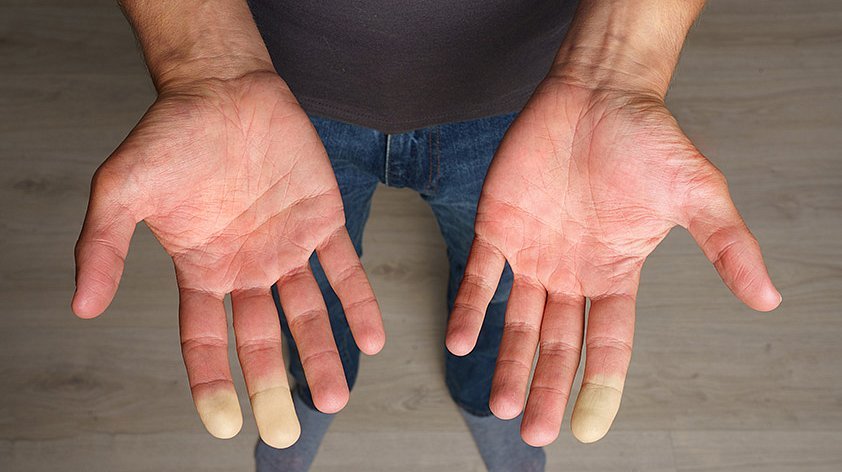 Почему синеют пальцы? Что нужно знать о синдроме Рейно