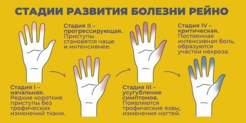 Стадии развития синдрома Рейно