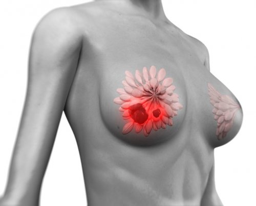 Ученые нашли способ уменьшить вероятность возвращения рака груди