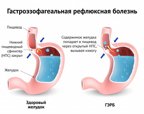 Как развивается изжога