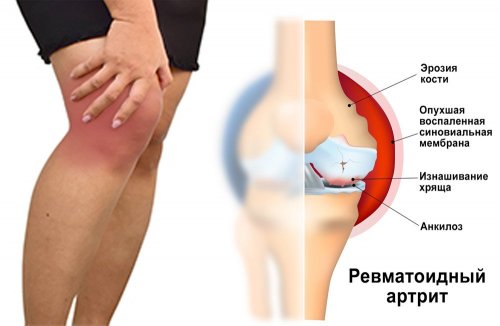 Ревматоидный артрит