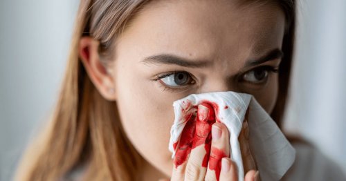 Почему нельзя запрокидывать голову при кровотечении из носа