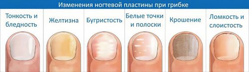 Как выглядят ногти при грибке