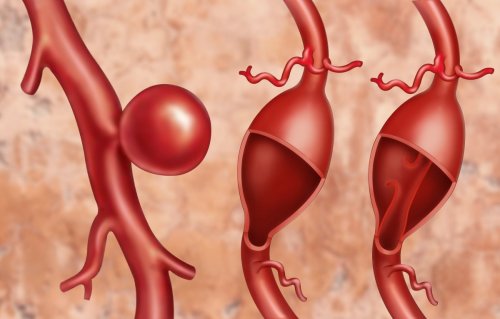 Аневризма аорты: как распознать и что делать?