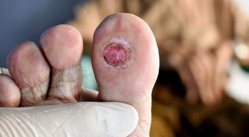 Создан специальный гель для заживления диабетических ран