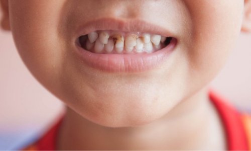 Сильный кариес в детстве может повлиять на сердце во взрослом возрасте