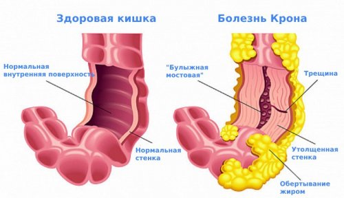 Болезнь Крона