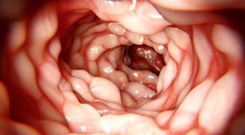 Болезнь Крона: симптомы, причины, лечение