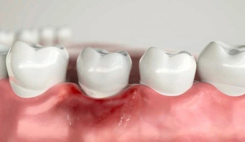 Почему зубные импланты могут не прижиться: 7 важных причин