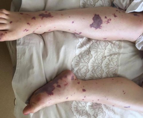 Сыпь при менингококковой инфекции