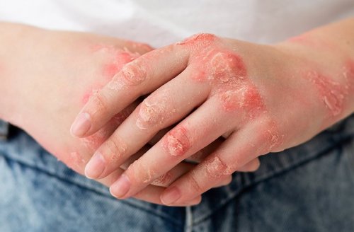 Себорейный дерматит: что это и почему он появляется