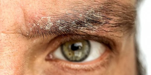 Себорейный дерматит