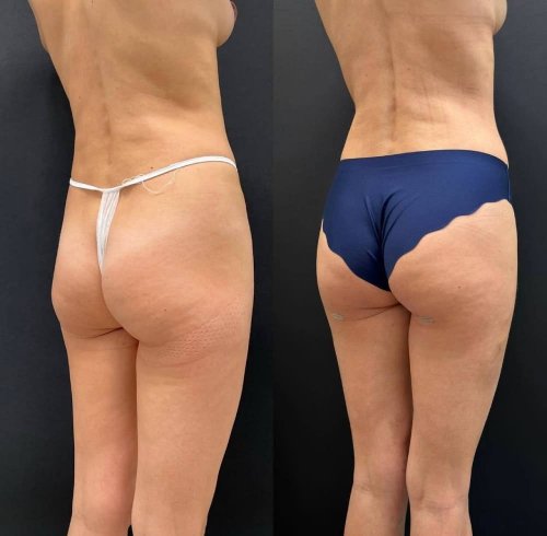 Липофилинг ягодиц