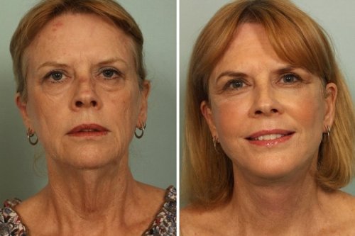 Липофилинг лица