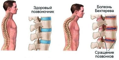 Болезнь Бехтерева